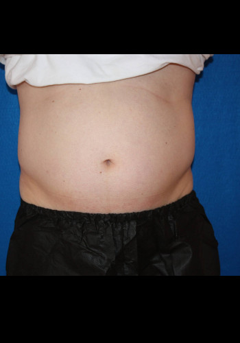 CoolSculpting