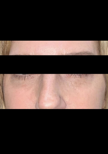 Eyelid Surgery