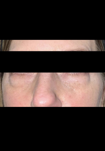 Eyelid Surgery