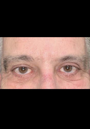 Eyelid Surgery