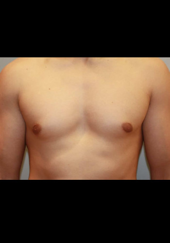 Gynecomastia (Male Breast Reduction)