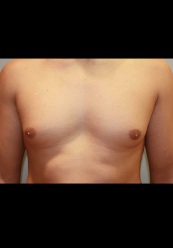 Gynecomastia (Male Breast Reduction)