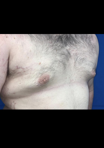 Gynecomastia (Male Breast Reduction)