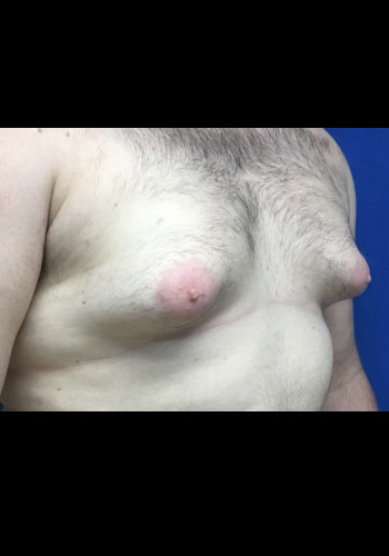 Gynecomastia (Male Breast Reduction)