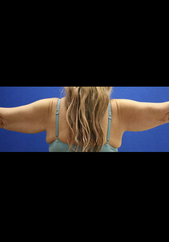 Arm Lift