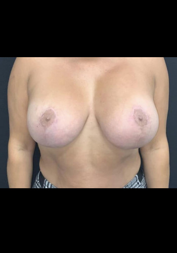 Breast Lift