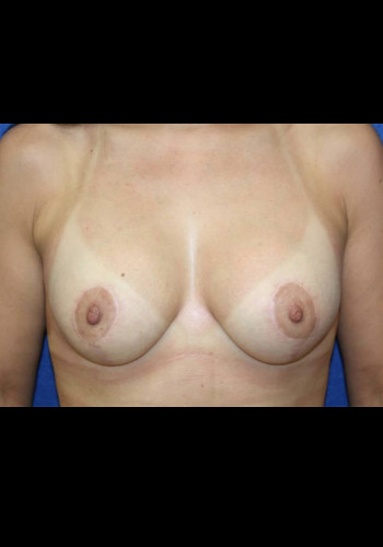 Breast Lift