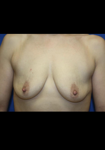 Breast Lift