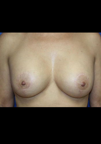 Breast Lift